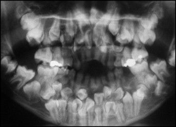 Bé gái 11 tuổi có tới 81 chiếc răng trong miệng, hình ảnh X-quang gây sốc- Ảnh 2.