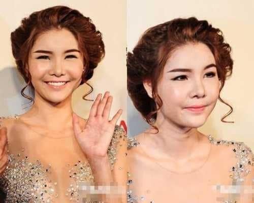 Người mẫu Việt tự khui ảnh thẩm mỹ mặt, thừa nhận rơi khủng hoảng vì sợ biến dạng vĩnh viễn- Ảnh 4.