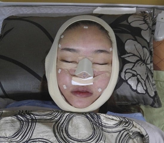 Người mẫu Việt tự khui ảnh thẩm mỹ mặt, thừa nhận rơi khủng hoảng vì sợ biến dạng vĩnh viễn- Ảnh 6.