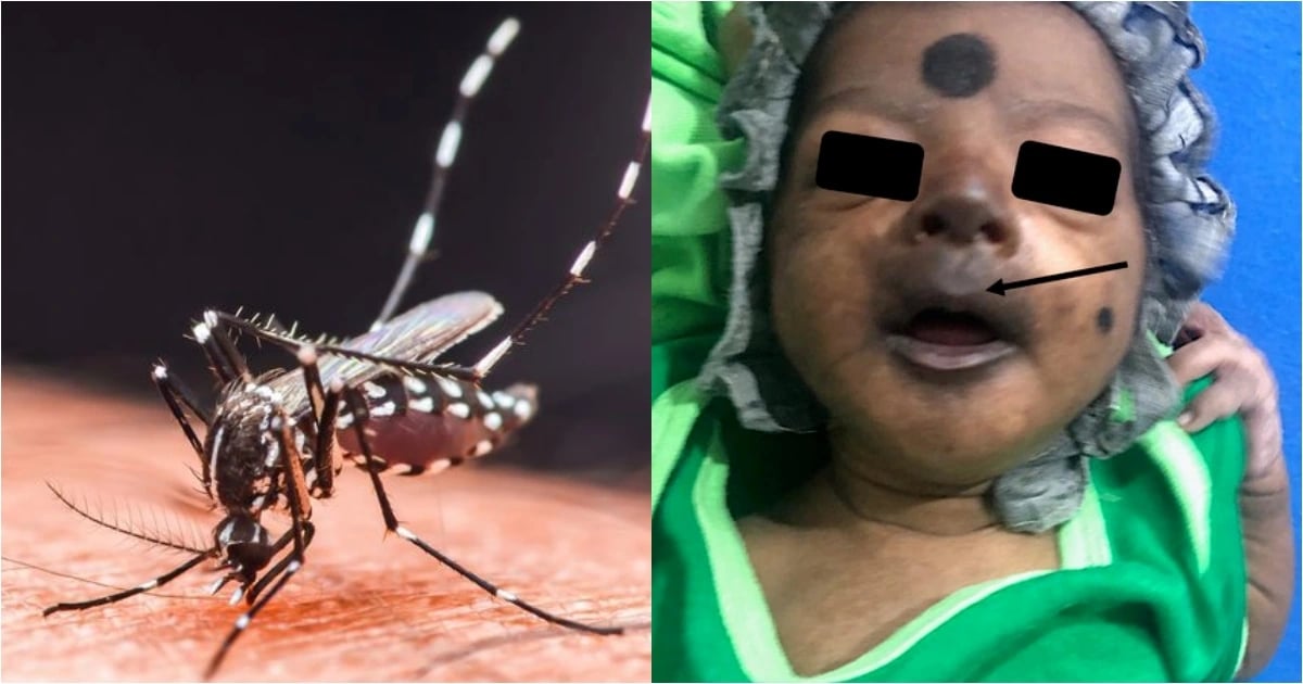 chikungunya tung khien be so sinh mat tim den, phai nhap vien cap cuu khan cap hinh anh 1