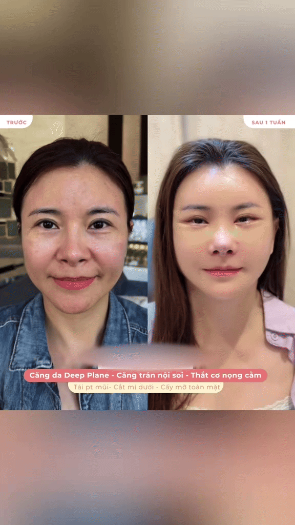 Diễn viên Kim Oanh lên tiếng sau khi gây tranh cãi vì phẫu thuật thẩm mỹ cả gương mặt- Ảnh 1.