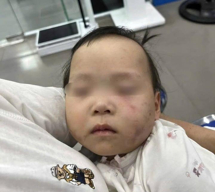 Bé gái 1 tuổi bị bầm tím mặt khi gửi nhà trẻ ở Bắc Ninh: Công an tạm giữ cô giáo- Ảnh 1.