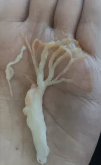 Người phụ nữ ho ra 