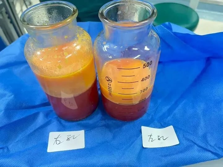 Nam thanh niên phát triển ngực như phụ nữ vì sai lầm khi tập gym- Ảnh 1.