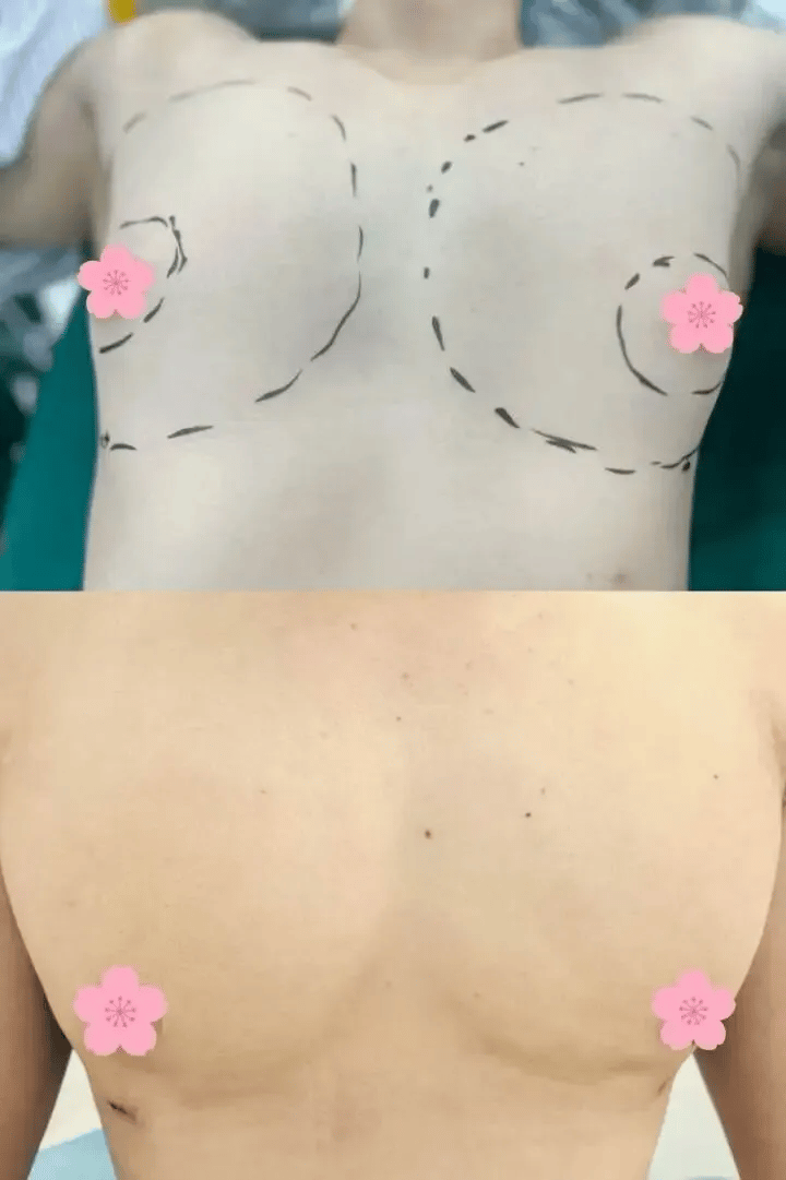 Nam thanh niên phát triển ngực như phụ nữ vì sai lầm khi tập gym- Ảnh 2.