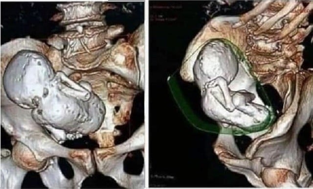 Chụp CT cho cụ bà 73 tuổi, bác sĩ sốc nặng khi phát hiện thai nhi hóa đá 30 năm- Ảnh 1.
