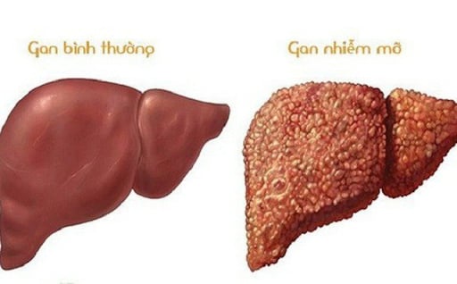 6 loại nước uống rẻ tiền giúp thải độc gan, tốt cho người bệnh gan nhiễm mỡ - Ảnh 1.