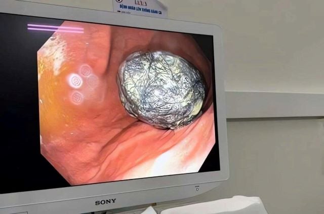 bui-toc-trong-da-day-be-gai-5-tuoi