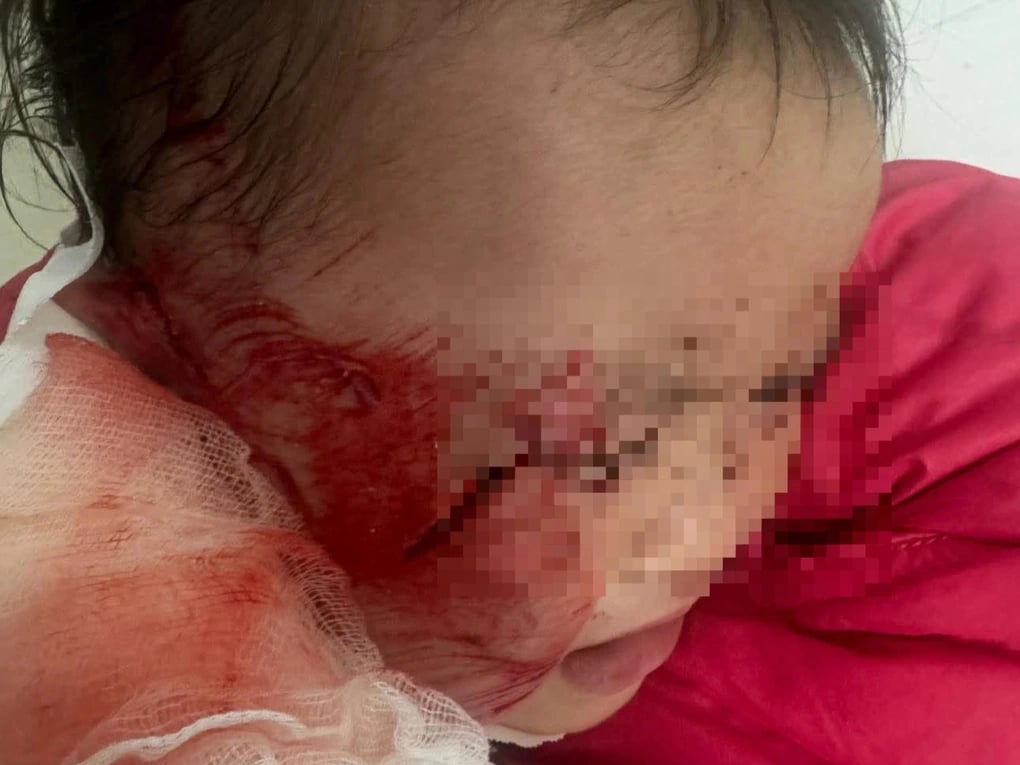 Vụ trần thạch cao sập xuống trẻ tại trường: Chưa thống nhất bồi thường - 2