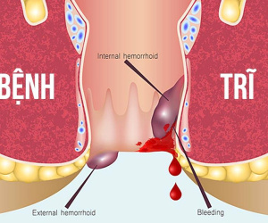 Những yếu tố nào khiến bệnh trĩ ngày càng trẻ hóa và phổ biến?