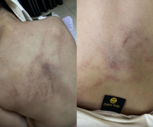 Bộ Y tế vào cuộc, trưng cầu giám định bé 4 tuổi bị cô giáo bạo hành