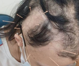 Đột nhiên tóc rụng từng mảng tới "hói trắng cả đầu", nữ sinh bàng hoàng khi nghe bác sĩ tiết lộ nguyên nhân