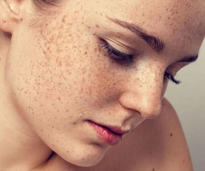 Bác sĩ da liễu chỉ "tuyệt chiêu" chống lại kẻ thù gây sạm nám da